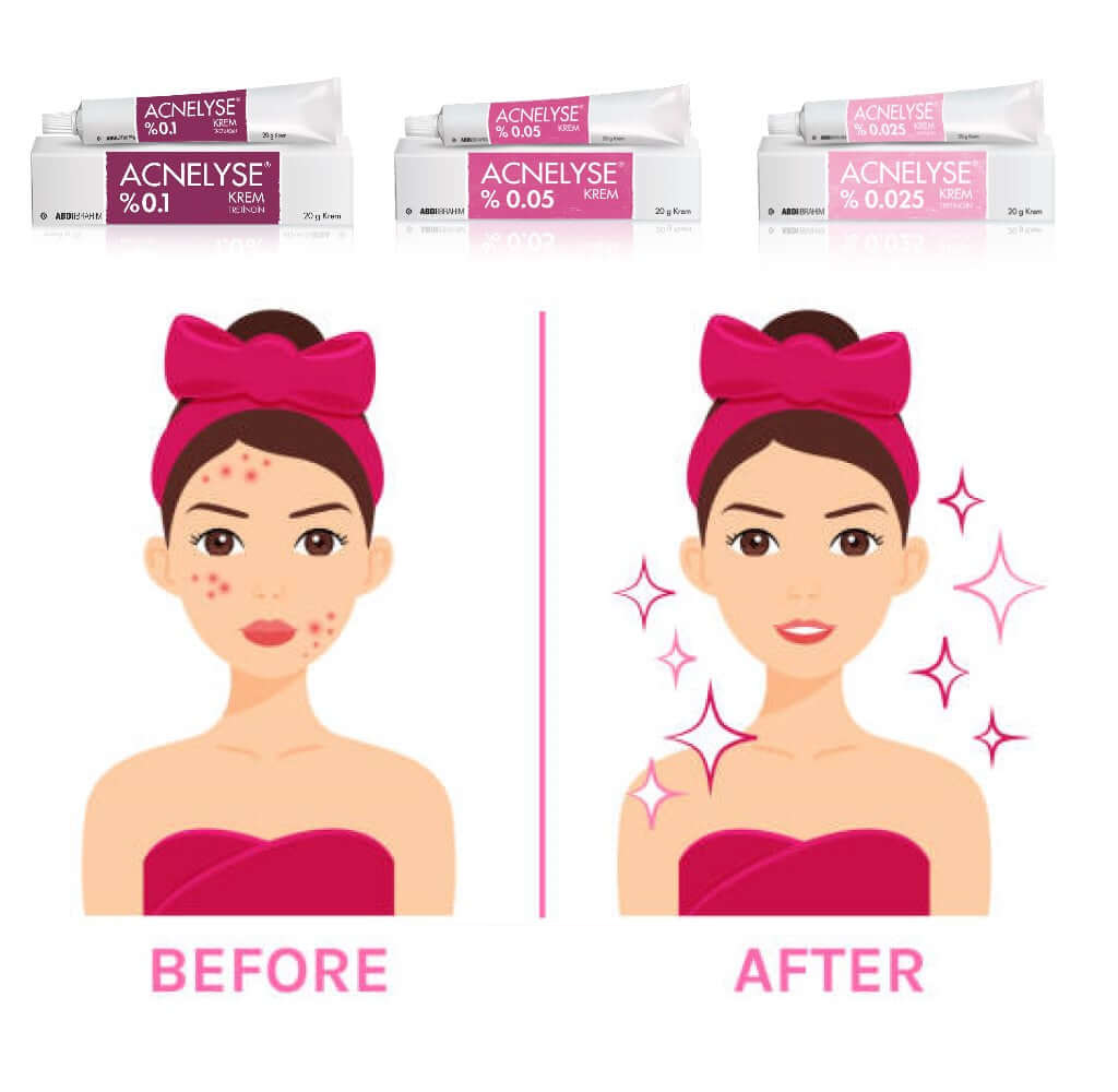 ACNELYSE%0.025 Skin Cream Acne Treatment Skin Renewal Anti Aging Cream For Daily Use Tretinoin 0.025