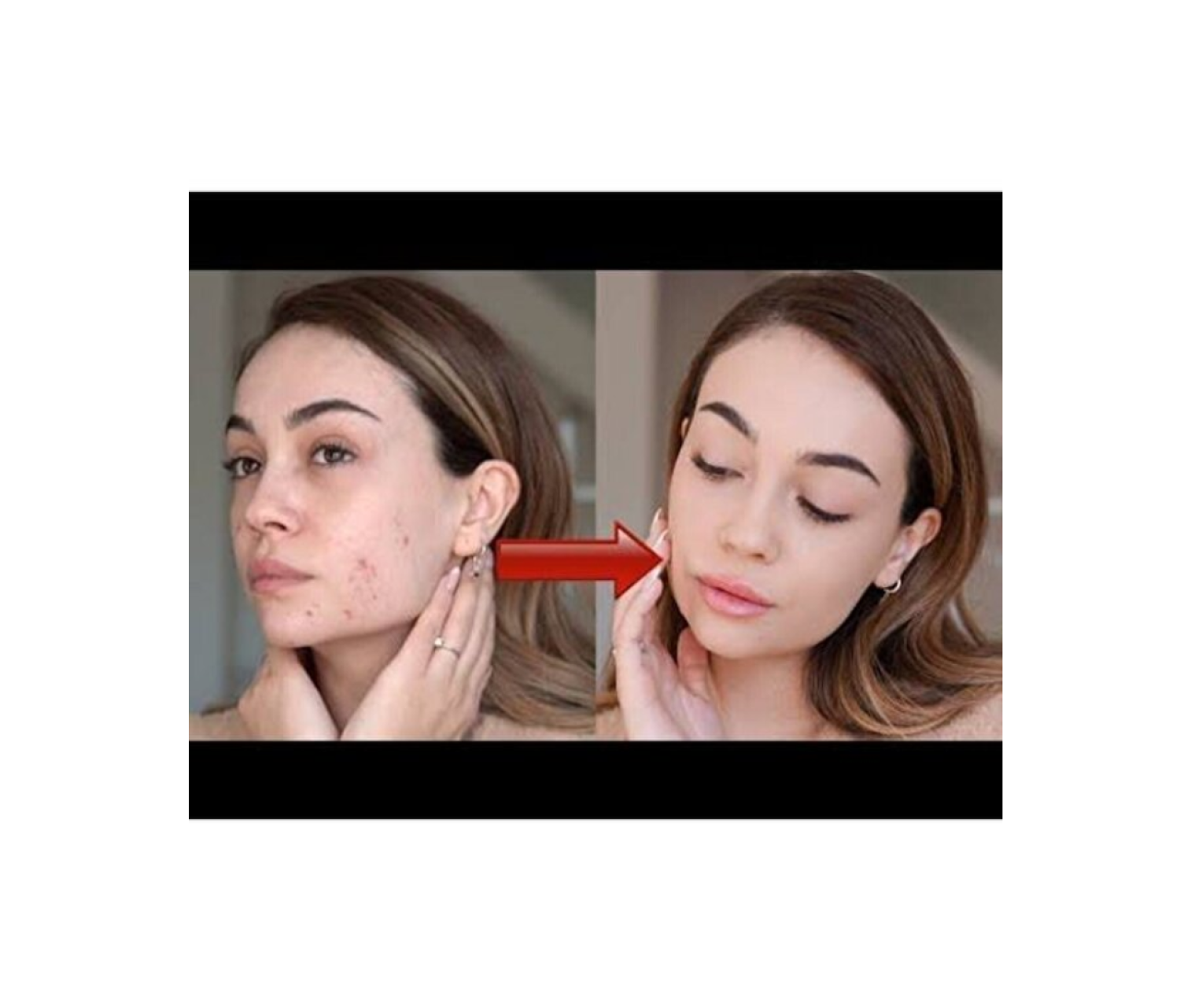 Imex Acne Cream 20 g – Antibacterial Ointment with 3% Tetracycline for Acne and Blemish Treatment