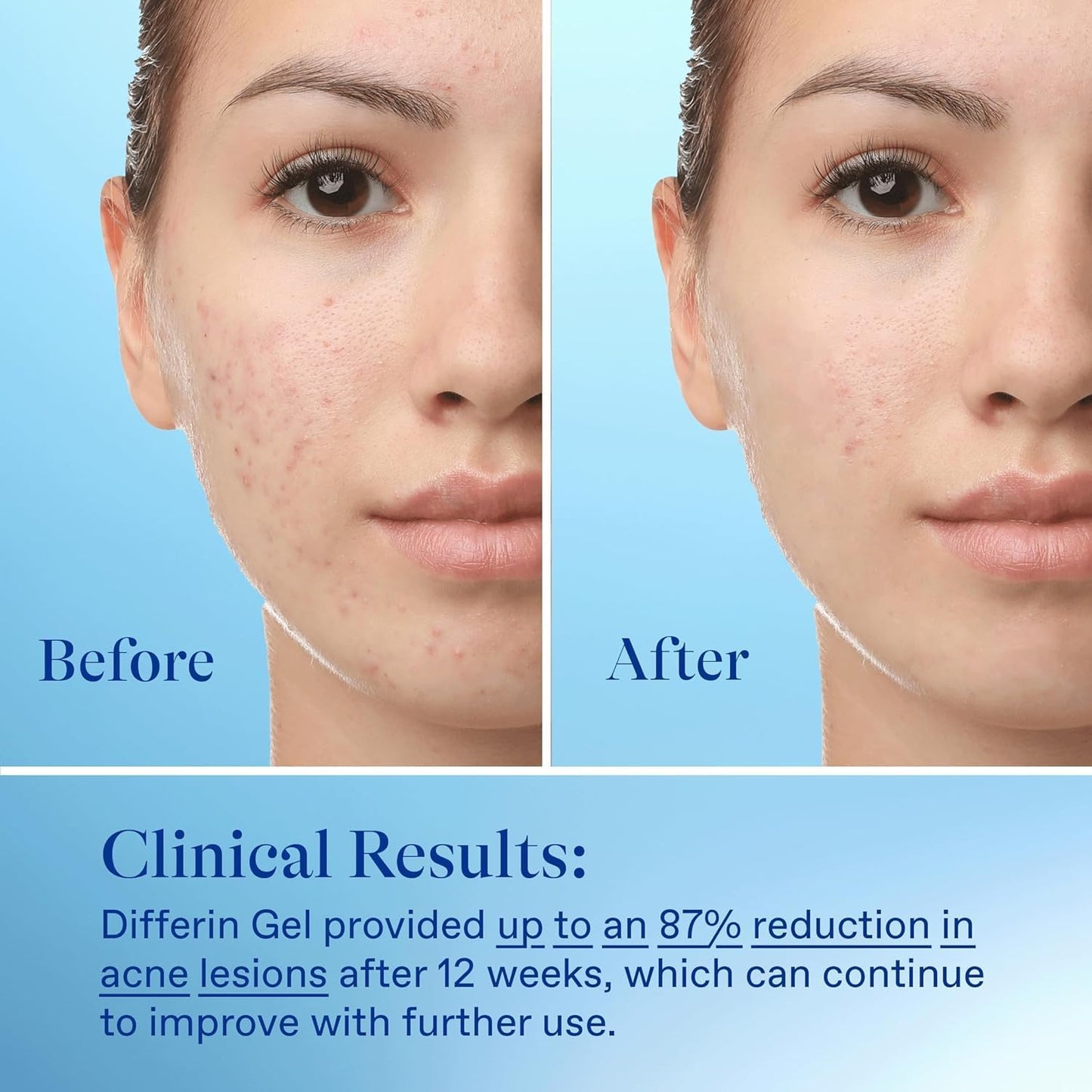 Differin Acne Treatment Gel, Retinoid Treatment for Face with 0.1% Adapalene, Gentle Skin Care for Acne Prone Sensitive Skin, 15g Tube